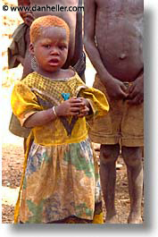images/Africa/BurkinaFaso/People/vitamin-deficiency.jpg